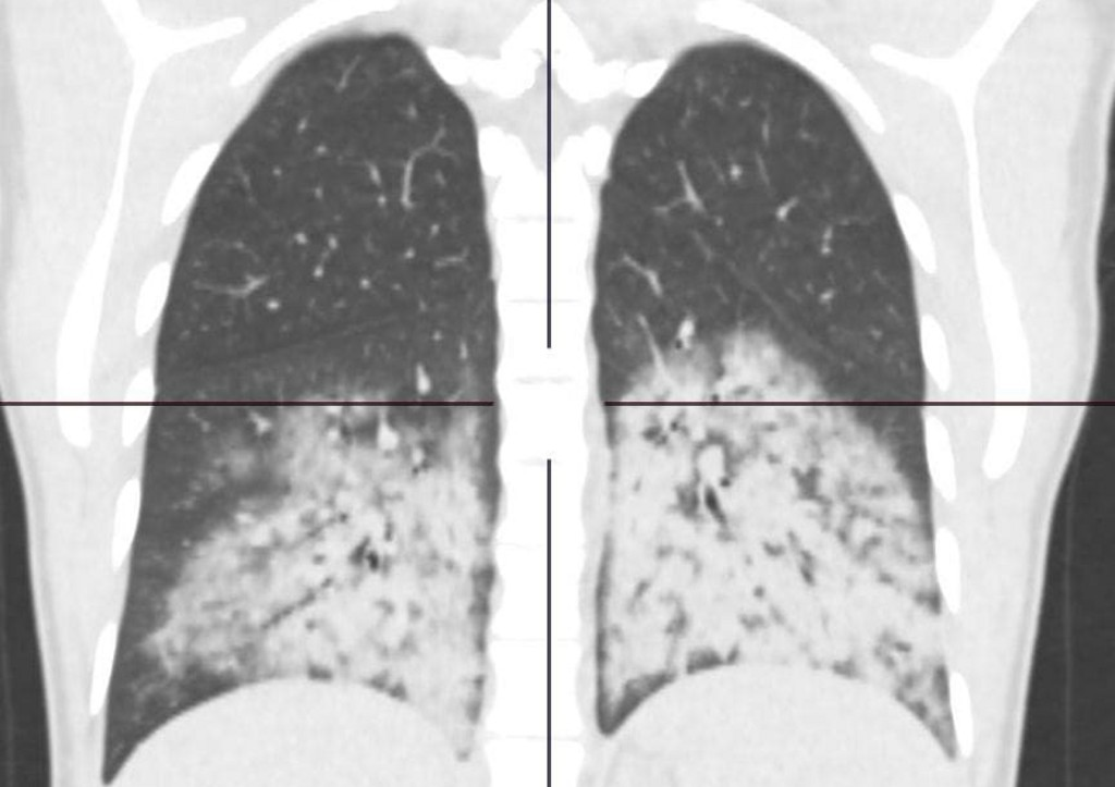 Снимок лёгких с диагнозом EVALI (E-cigarette, or vaping, product use associated lung injury). Фото из Сети.