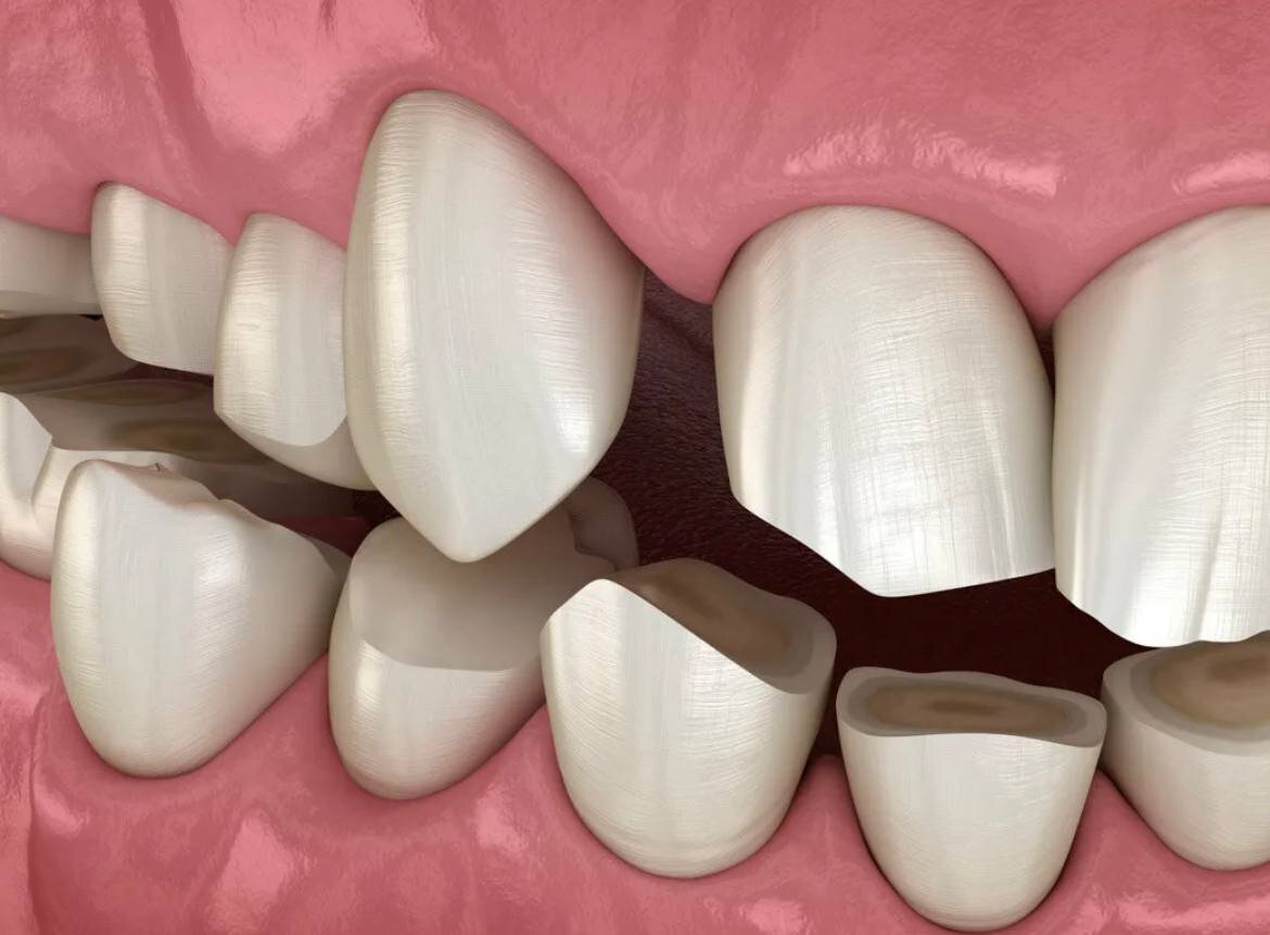 истирание тканей зубов