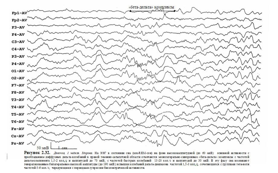 Нормы ээг у детей. ЭЭГ волны. Бета ритм на ЭЭГ норма у ребенка. Альфа активность на ЭЭГ норма. ЭЭГ принцип метода.