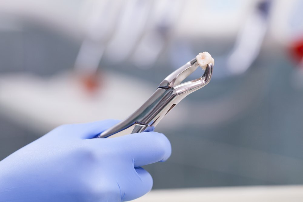 Современная стоматология имеет в своем арсенале множество методов, позволяющих сохранить даже проблемные зубы. Однако в некоторых случаях удаления все-таки не избежать.-2