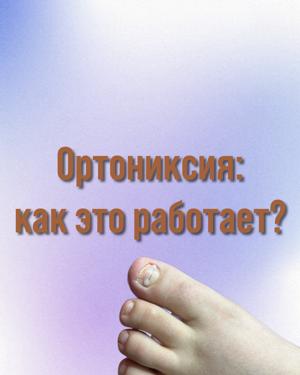 Ортониксия — наука, которая изучает проблемы вросших ногтевых пластин и их дальнейшую коррекцию 
