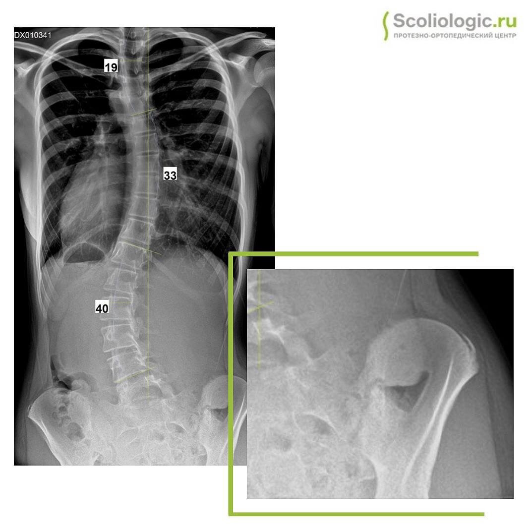 Тест риссера при сколиозе. Тест риссера рентген. Индекс риссера рентген. Идиопатический сколиоз.