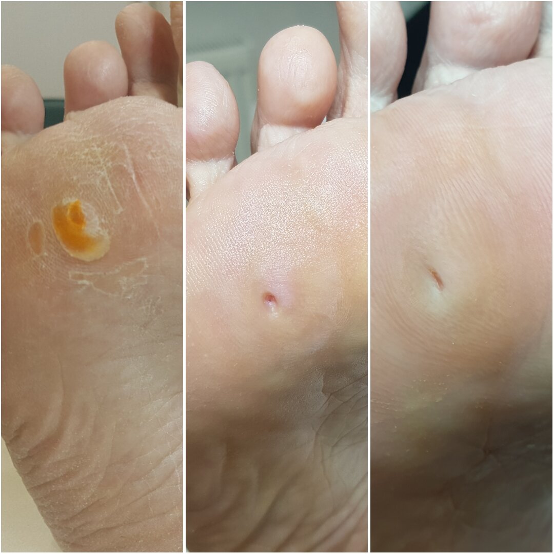 Натоптыш на стопе. Под ним - мозоль со стержнем.