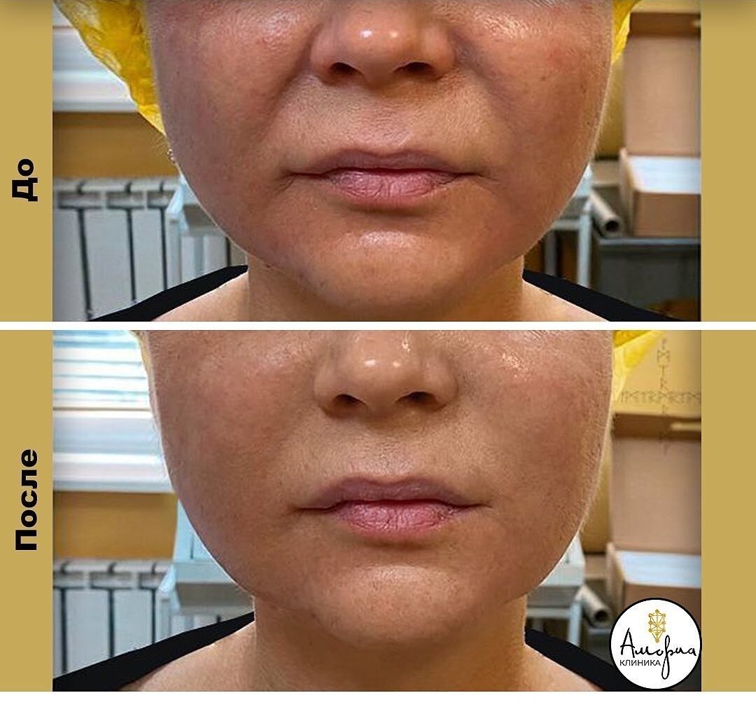 Результат до и после Альтеры. 388 линий