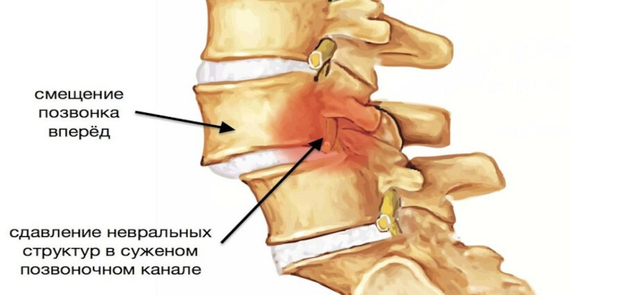 Листез, спондилолистез: причины, симптомы, лечение