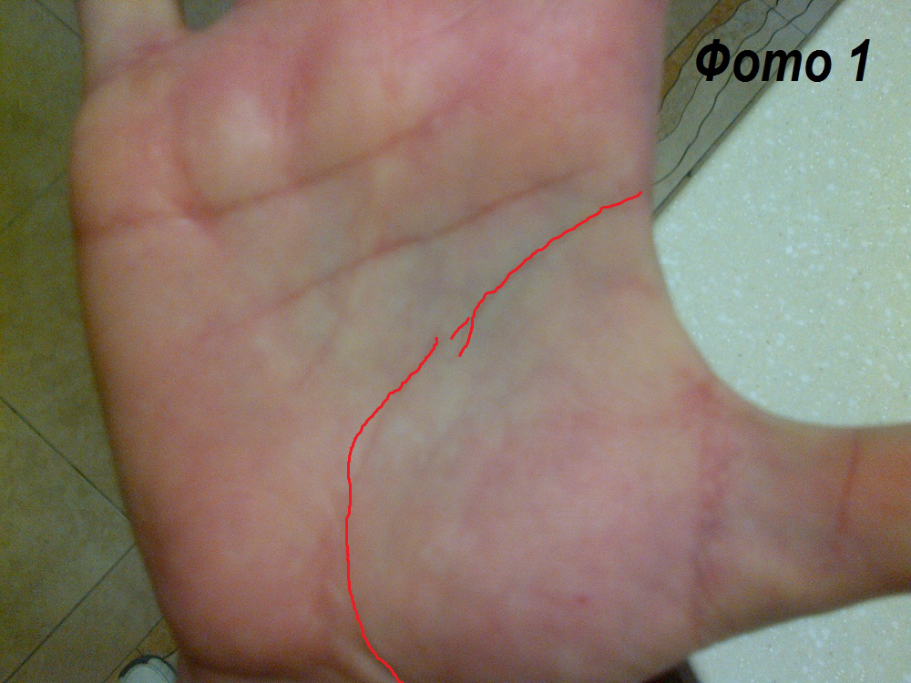 Вилочковый разрыв линии жизни. Моя редакция.