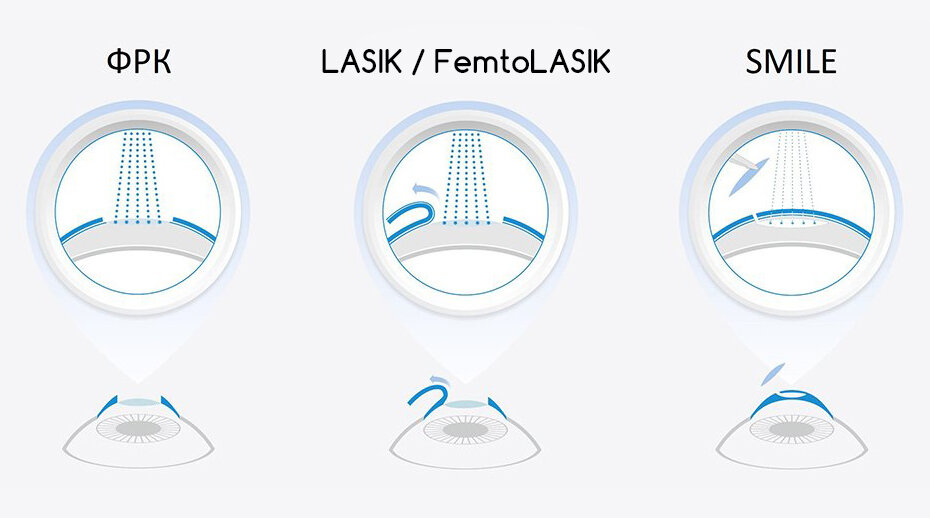 Три поколения методов коррекции зрения