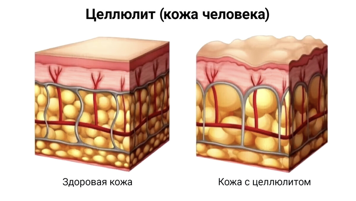 Кожа становится рыхлой и при этом увеличены жировые клетки и кожа обычно тонкая. Циркуляция крови прекращается и иногда происходит задержка жидкости, лимфатическая система может быть закупорена. Как правило при целлюлите мышцы атрофированы.