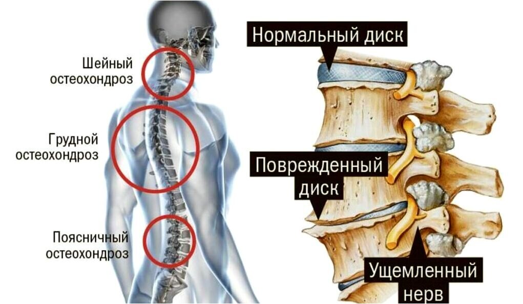 Шейный остеохондроз - симптомы, признаки и лечение