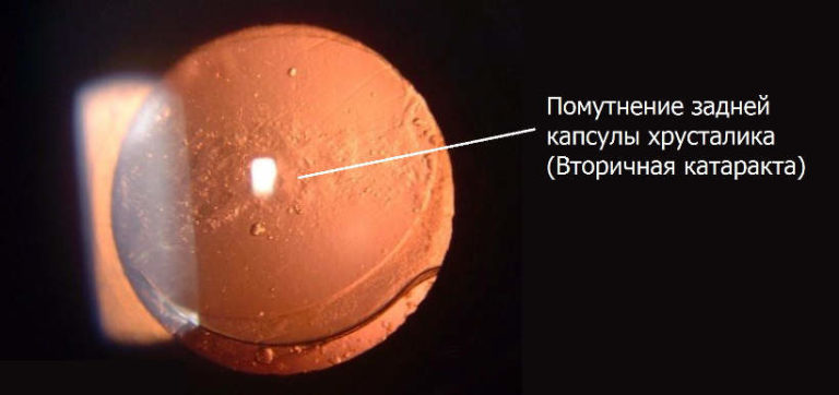 Катаракта после. ИАГ лазерная дисцизия вторичной катаракты. Вторичная катаракта шары Адамюка-Эльшнига. Лазерная дисцизия задней капсулы хрусталика. Вторичная катаракта помутнение задней капсулы.