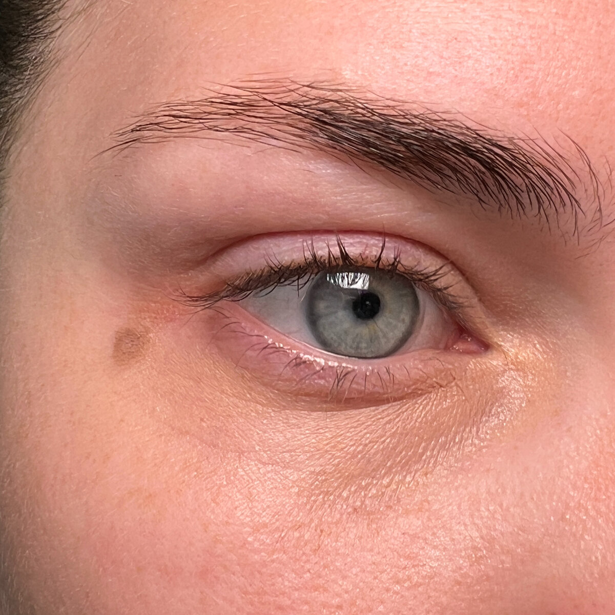 Почему появляются синяки под глазами и как от них избавиться