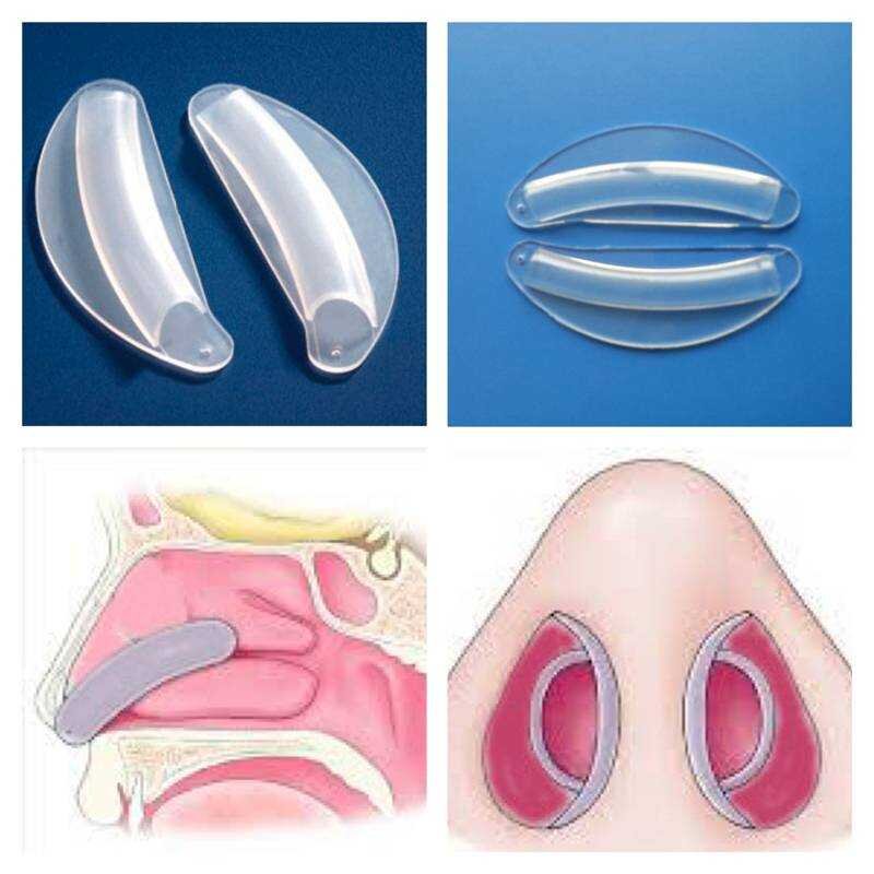 Септопластика. Сплинты для септопластики. Назальные силиконовые сплинты. Септопластика носовой перегородки операция. Интраназальные сплинты.