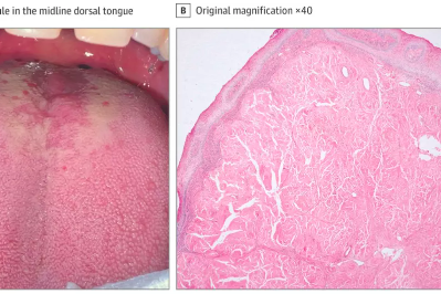     Загадочная шишка на языке не давала покоя мужчине — но ее причина поразила даже врачей