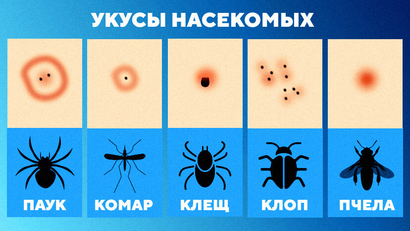 Укусы домашних насекомых — аллергия