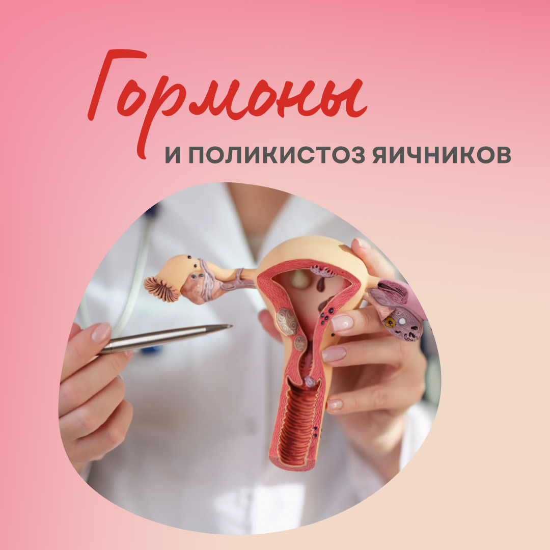   Синдром поликистозных яичников (ПКЯ) – это расстройство эндокринной системы, которое связано с гормональными нарушениями у женщин.