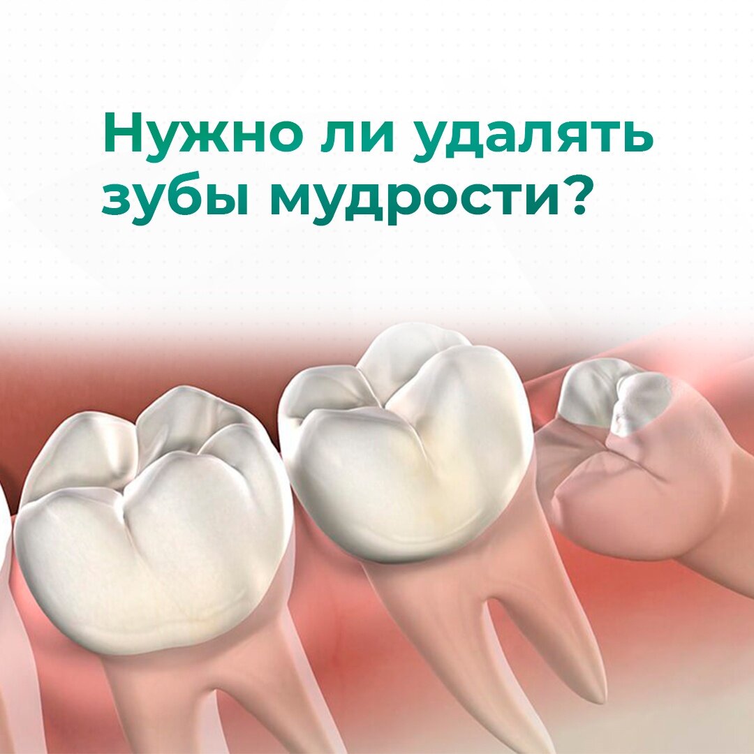 Нужно ли удалять зубы мудрости?🦷 | Стоматология 