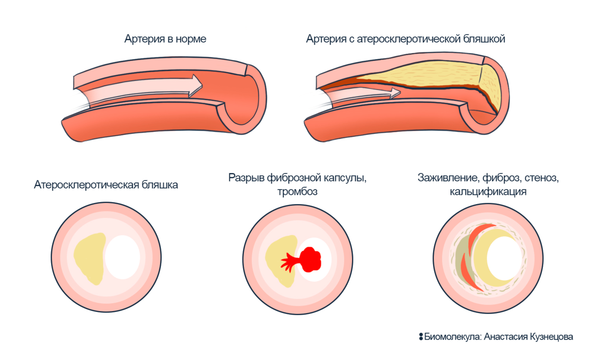 clogged_arteries | VitaWorld