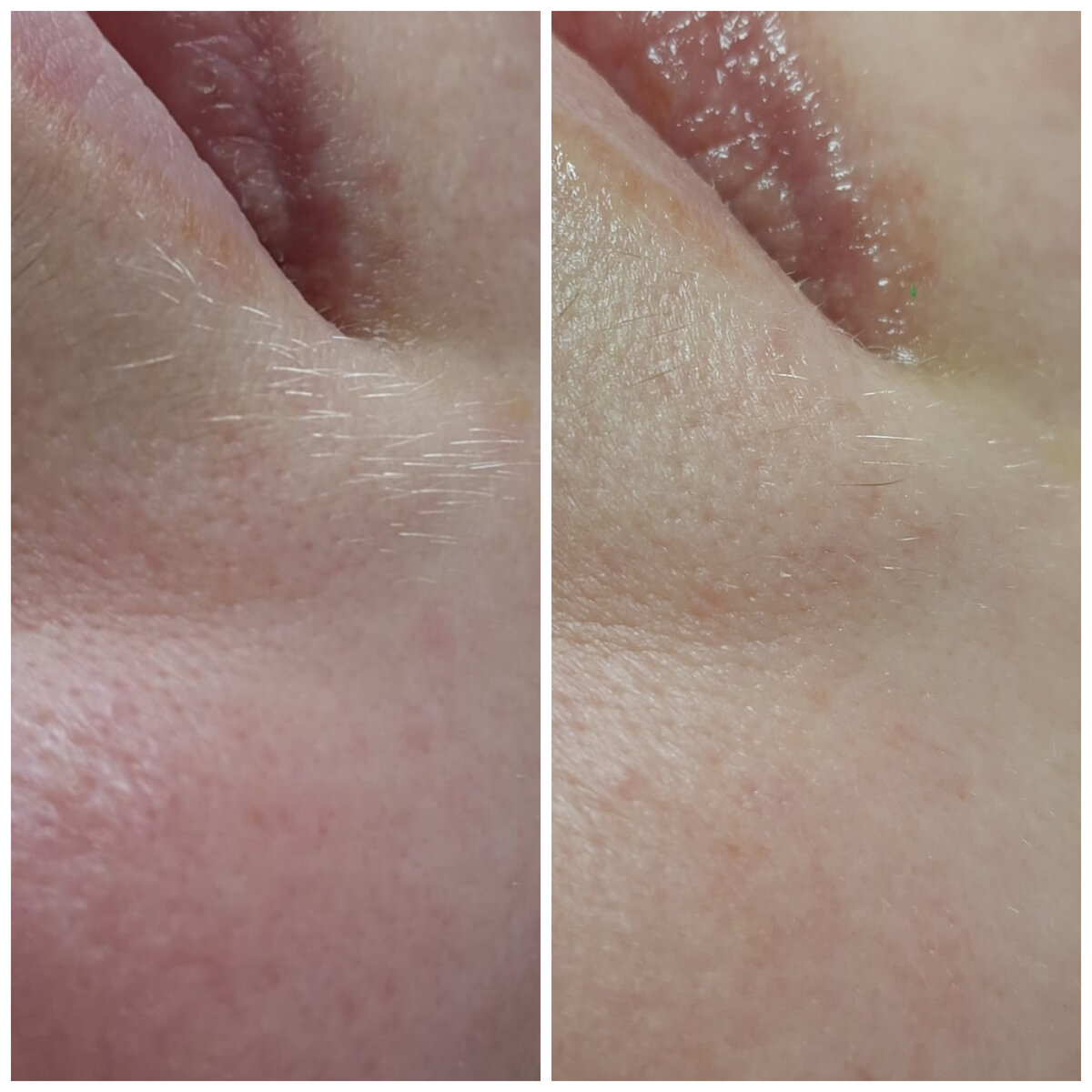 До и после 2х процедур