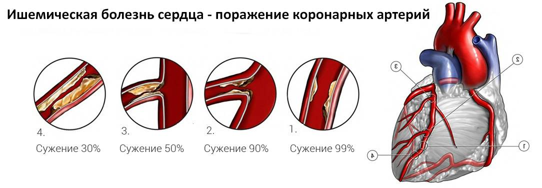 Ибс. Степени сужения коронарных артерий. Ишемическая болезнь сердца атеросклероз коронарных артерий. Ишемическая болезнь сердца (ИБС). Стеноз венечных артерий сердца