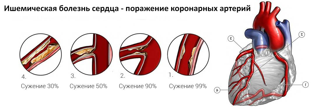 Симптомы ишемической болезни сердца у мужчин