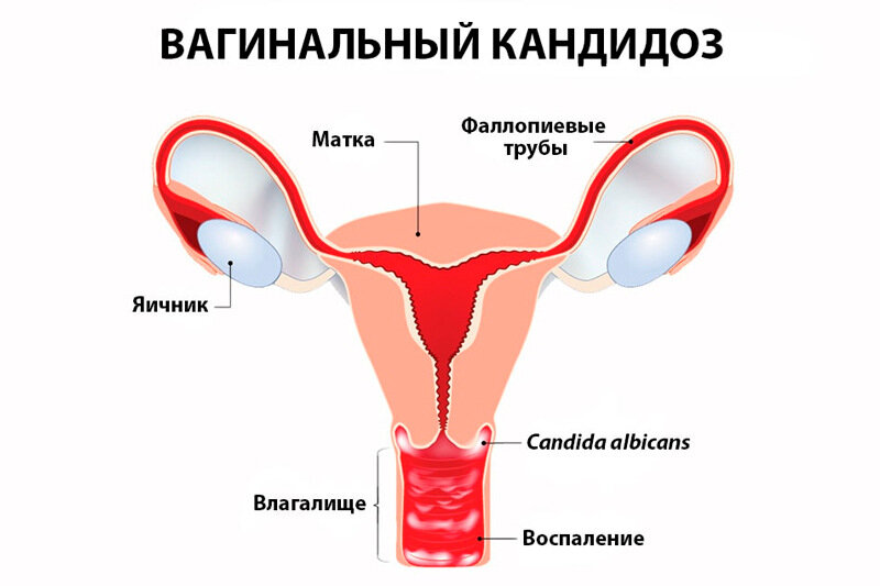 Вагинальная дрожжевая инфекция - Vaginal yeast infection