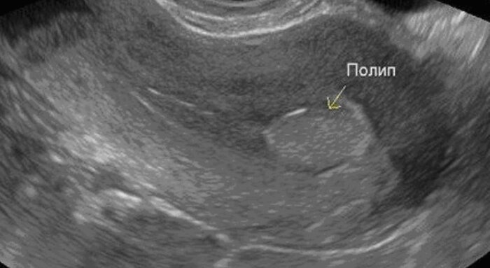 При полипе можно забеременеть. Полип или беременность на УЗИ. Полип и беременность форум. При полипе беременность сохранить.