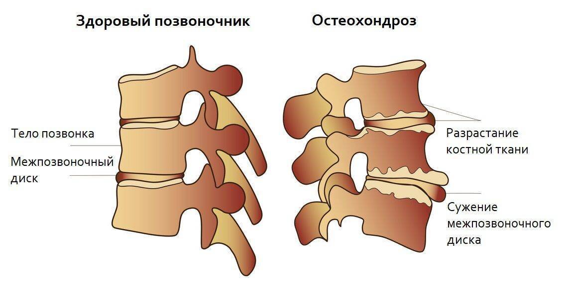 Причины остеохондроза позвоночника