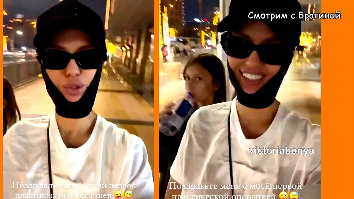 Вика Боня сделала первую в своей жизни пластическую операцию, инстаграм