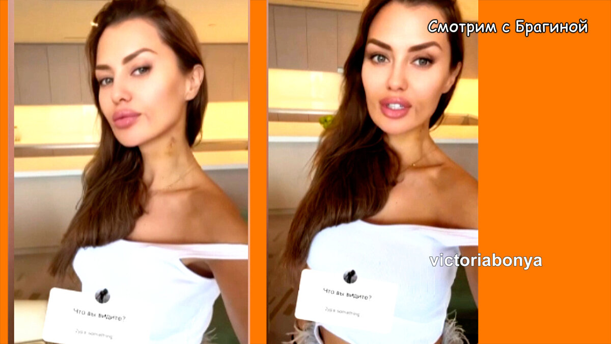 Вика Боня сняла повязку после операции, инстаграм