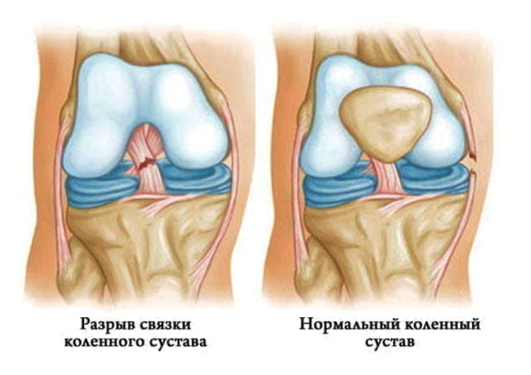 Частичное повреждение ПКС коленного сустава. Разрыв ПКС коленного сустава. ПКС связок коленного сустава. Механизм травмы передней крестообразной связки коленного сустава.