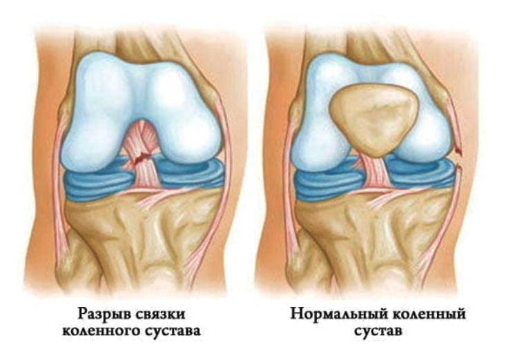 Передняя крестообразная связка коленного. Частичное повреждение ПКС коленного сустава. Разрыв ПКС коленного сустава. ПКС связок коленного сустава. Механизм травмы передней крестообразной связки коленного сустава.