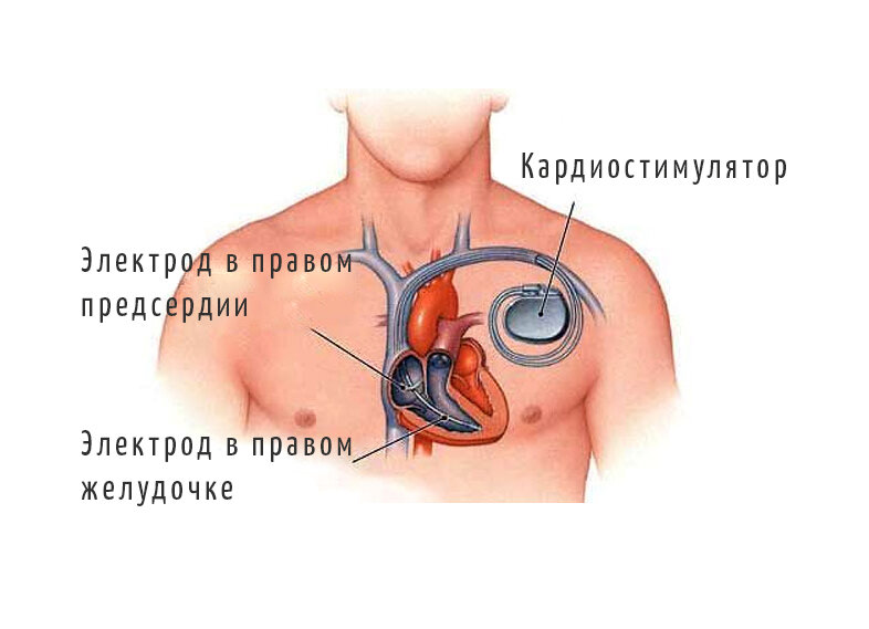 Брадикардия, вызванная заболеванием сердца, опасна, если она вызывает: Эти симптомы могут появляться уже при снижении пульса менее 50 ударов в минуту, но обычно возникают при немного более выраженном