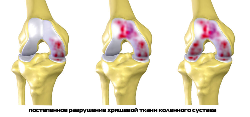 Опасен ли хруст в суставах