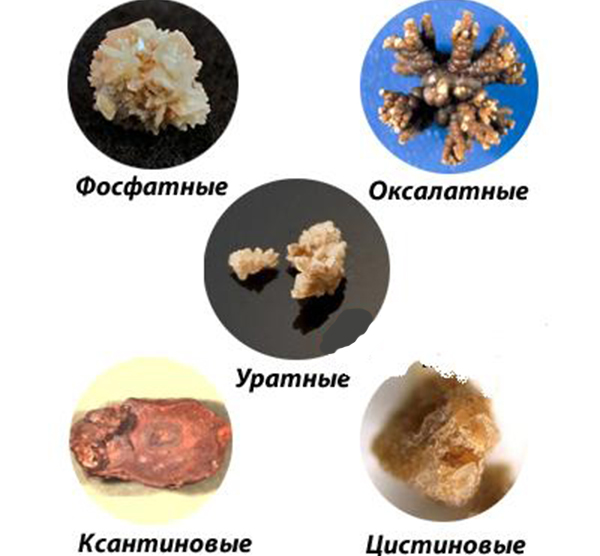 Источник фото: https://www.gdp3podolsk.ru/blog/kamni-v-pochkah-klassifikacija-simptomy 