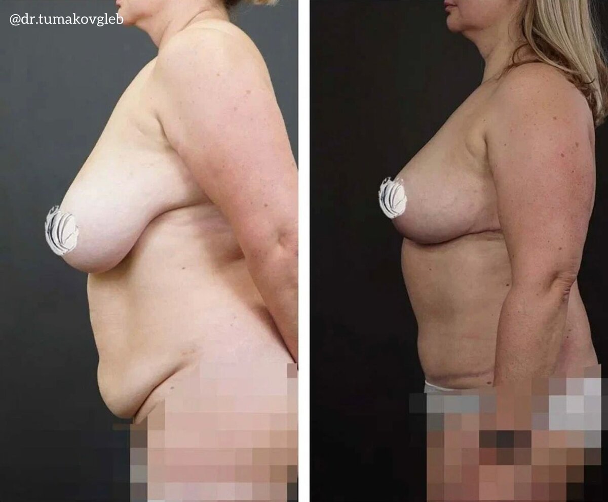 уменьшение груди у женщин фото 29