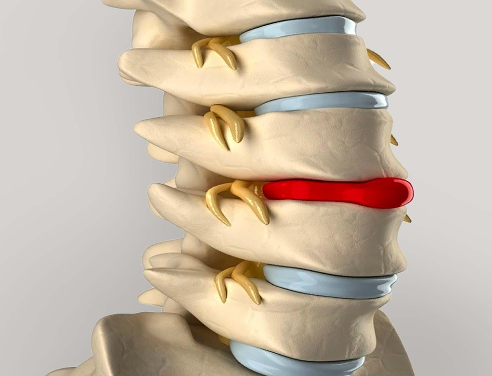 Межпозвоночная грыжа