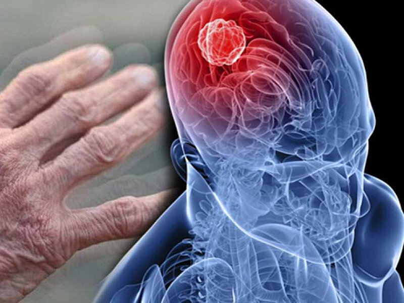 Болезнь Альцгеймера