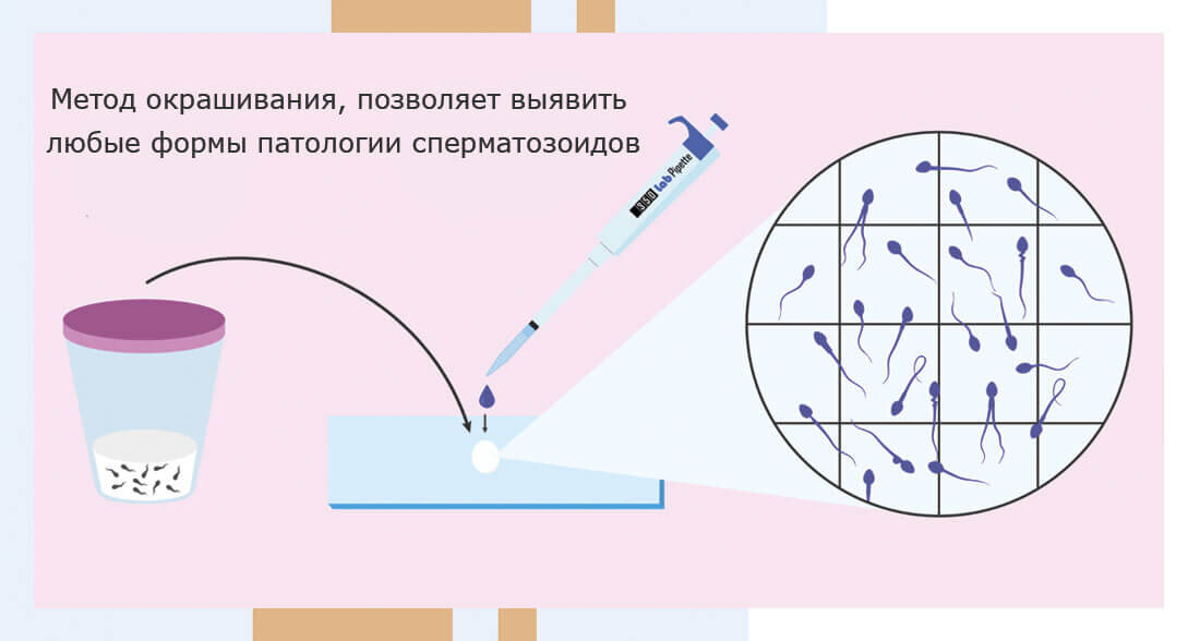 Морфология по Крюгеру