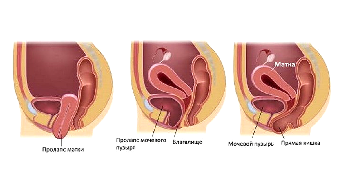 Виды пролапса
