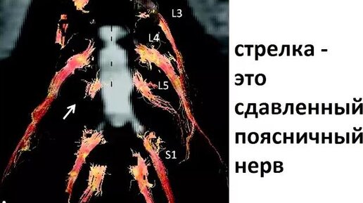 Каким образом грыжа диска сдавливает корешки и воспаляется?