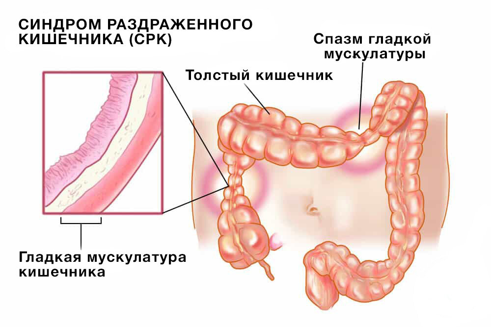 Синдром раздраженного кишечника (СРК)