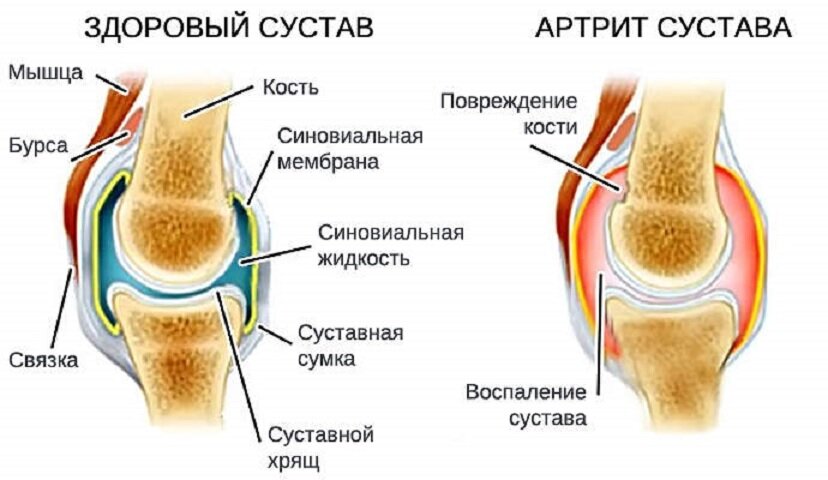 Артрит коленного сустава лечение. Артрит суставов коленного сустава симптомы. Деформирующий остеоартроз синовиальная жидкость. Острый артрит коленного сустава. Схема лечения артрита коленного сустава.