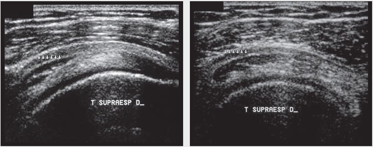 Рис. 2. (a), (b) Супраспинальные мышечные пучки, представленные эхоплотными полосами (стрелки) прикрепленные внутри сухожилия, имитируя перелом