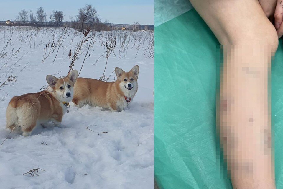     Собака укусила школьницу за ногу. Фото: предоставлено Дианой/предоставлено Александром Борщенко