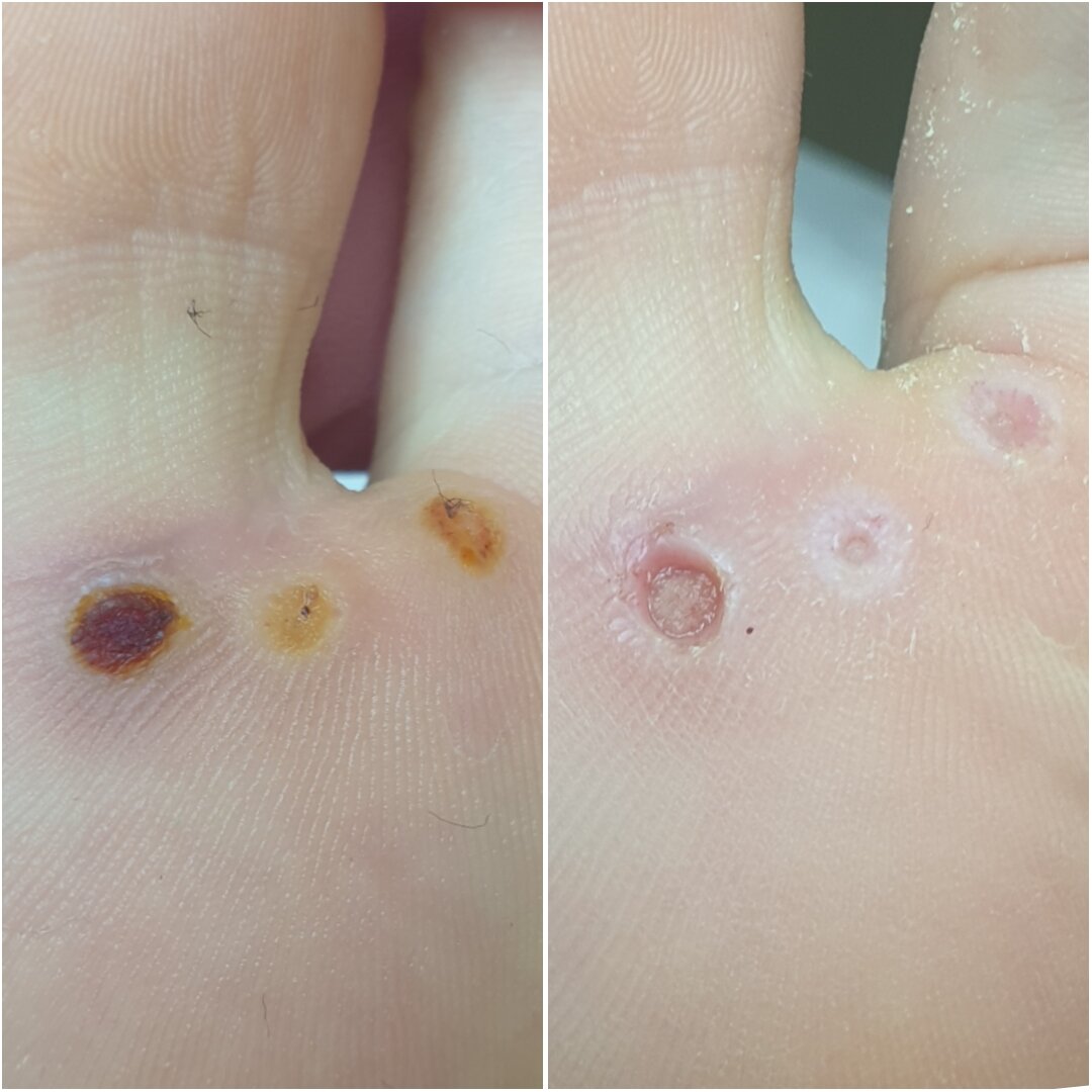 Как привести к удалению бородавки