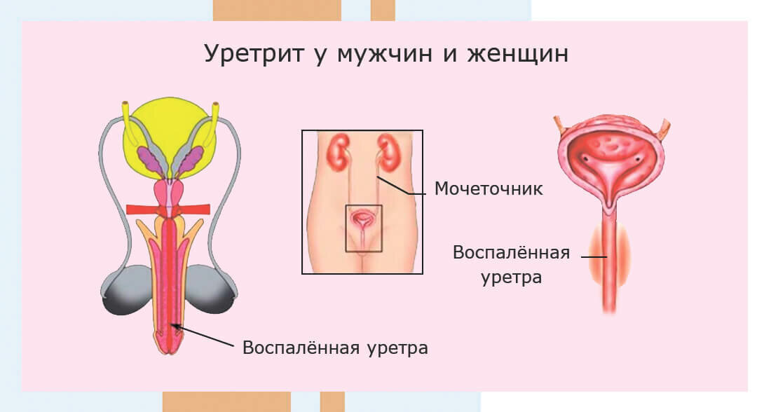 Уретрит у мужчин и женщин 