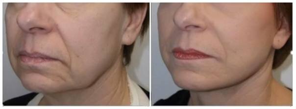 Обратите внимание на тон кожи и на губы,визуально скрыты наши несовершенства и вид стал намного свежее. Консилер очень хорошо справляется,но перед ним нанесите тонкий слой тонального крема