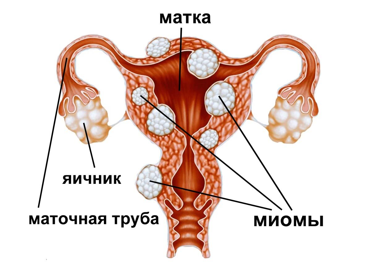 Что такое миома