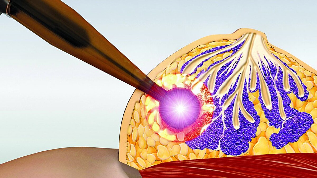 Можно ли делать увеличение груди, если есть киста или фиброаденома? |  Семейная Бьюти | Дзен