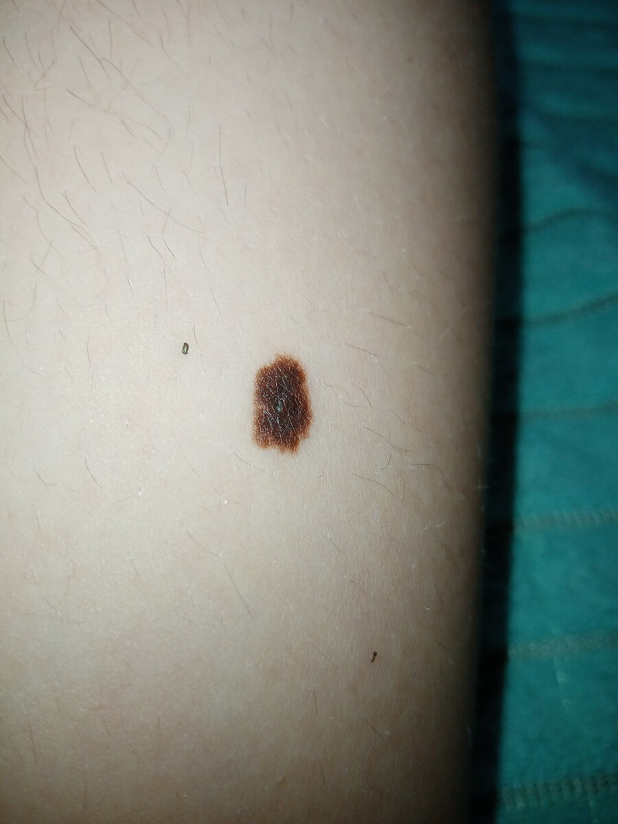 У дочки в 8 лет тоже нехорошая родинка. Сказали, что это еще не меланома, но нужно ее удалить, иначе она ей станет. Название ШПИЦ. Вроде так.